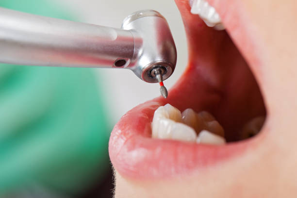 Best Emergency Dental Extractions in Bunkie, LA